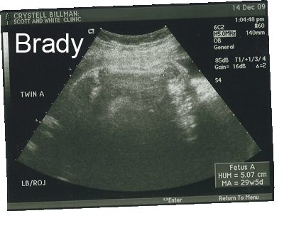 Brady’s Upper Arm